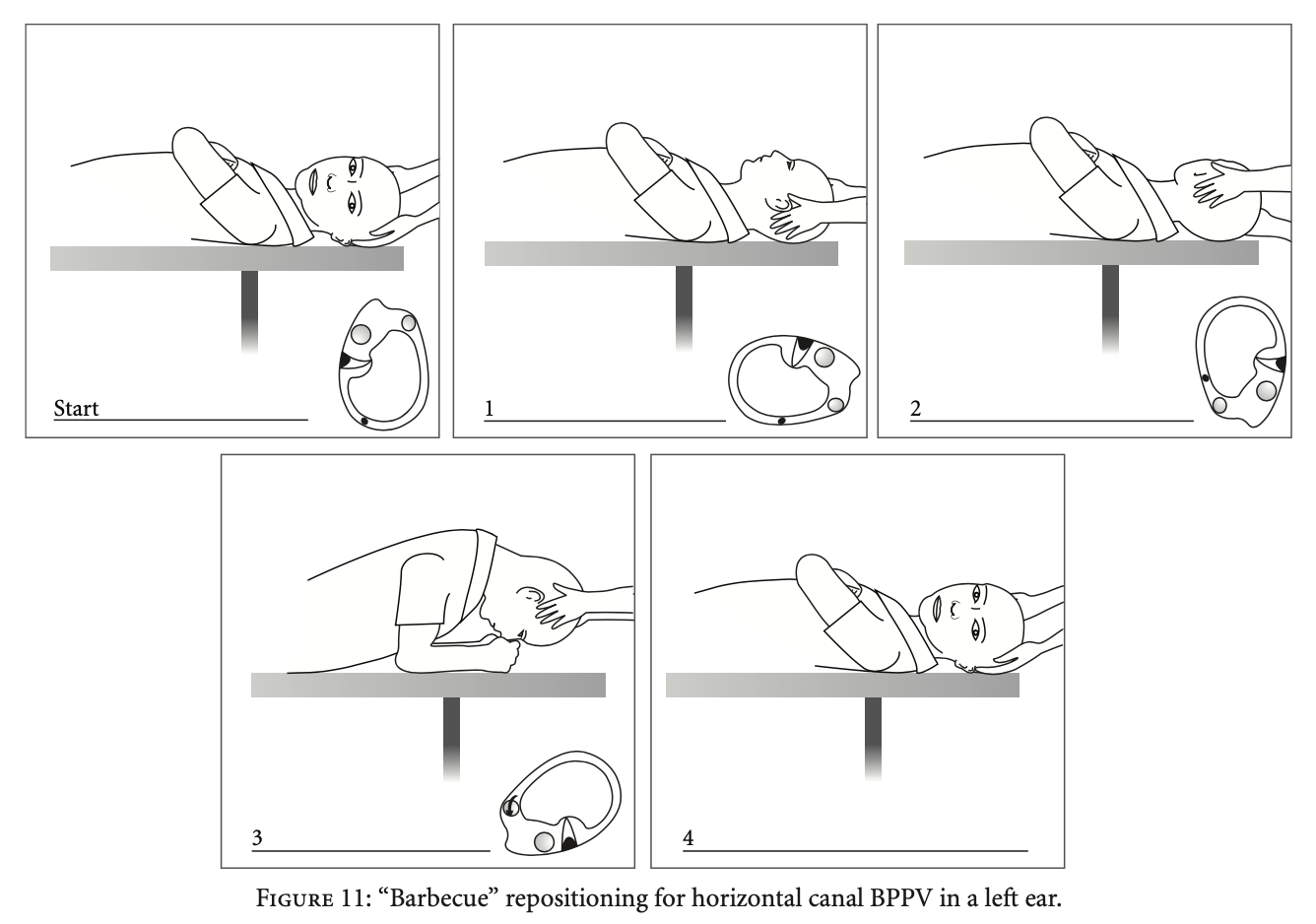 Figure: Left-sided Lempert roll for left sided lateral canal BPPV.  From Hornibrook (2011).