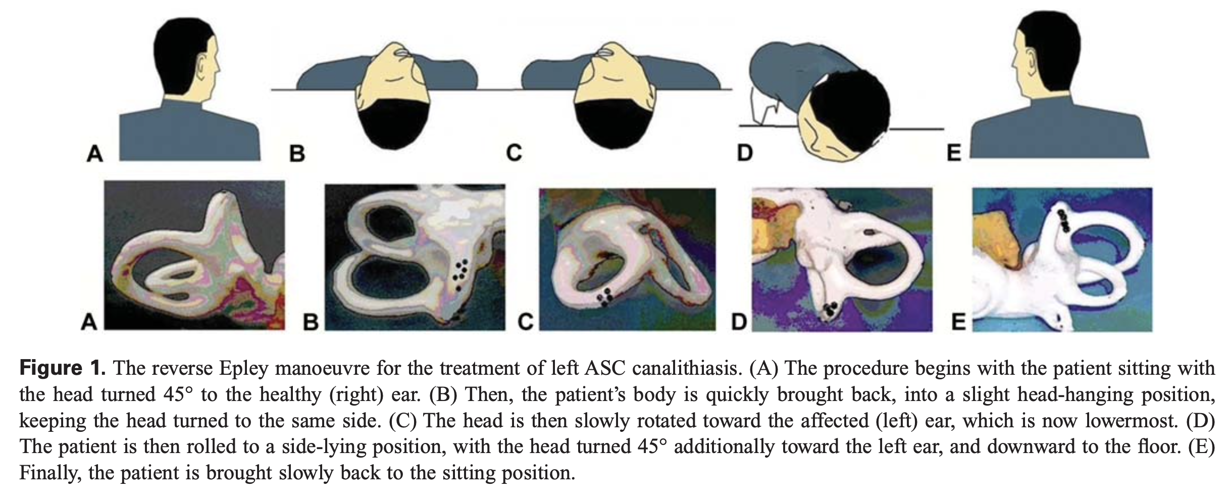 Figure: Reverse Epley maneuver for left anterior canal BPPV.  From Korres et al. (2010).