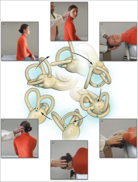Figure: Right-sided Epley maneuver for right-sided posterior canal BPPV.  From Kim and Zee (2014).