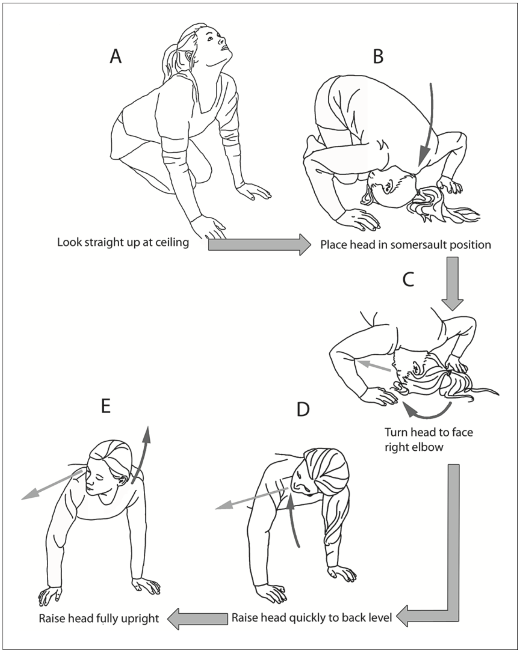 Figure: Right-sided Foster maneuver for treating right-sided posterior canal BPPV.  From Foster et al. (2012).