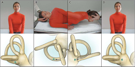 Figure: Right-sided Semont maneuver for right-sided posterior canal BPPV.  From Kim and Zee (2014).