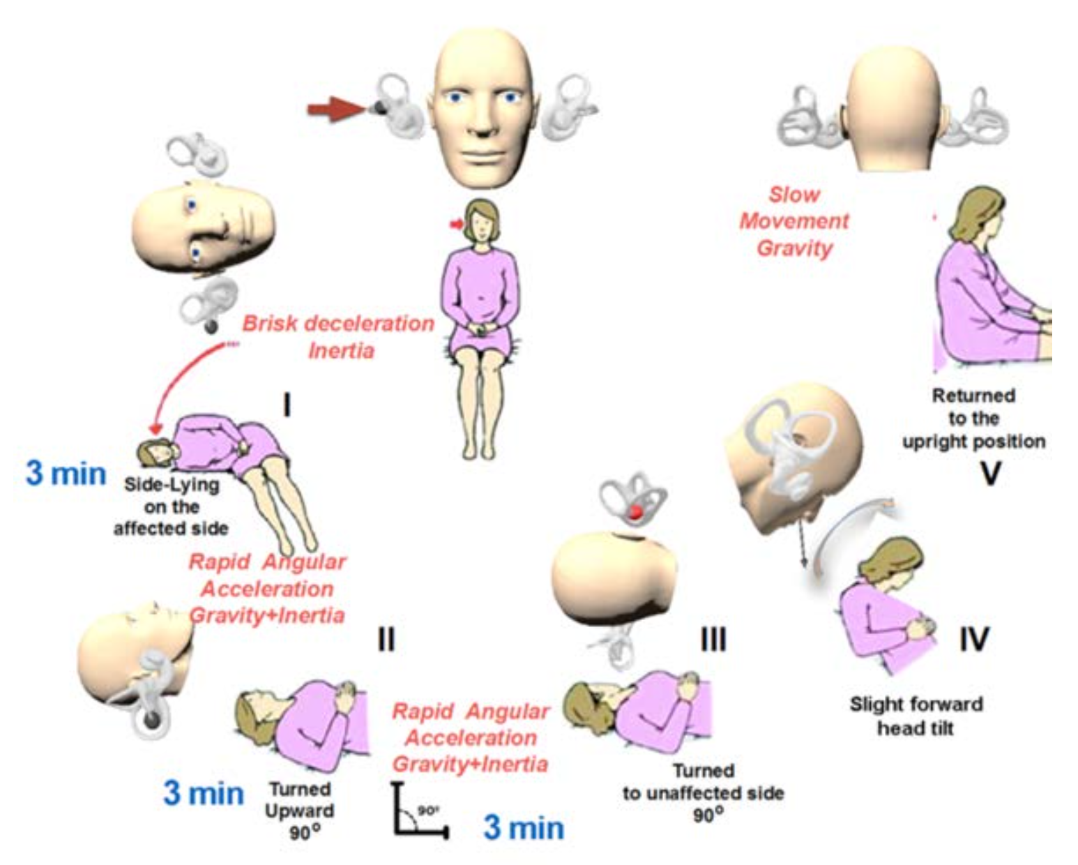 Figure: Right-sided Zuma maneuver for treating right-sided lateral canal apogeotropic BPPV.  From Zuma e Maia (2016).