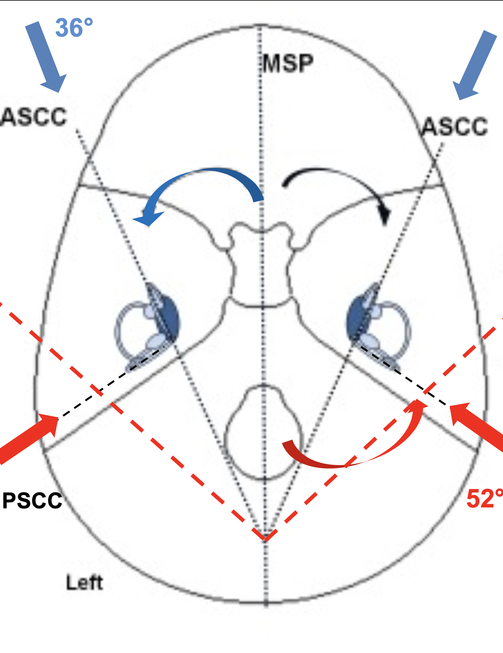 Figure: The plane of the anterior semicircular canals is angled more closely to the sagittal plane than to the coronal plane.  The blue arrows indicate the orientations of the planes of the ASSC (anterior semicircular canals).  Courtesy of Dr. Darío Yacovino, from a lecture delivered in 2020 at Cesar Milstein Hospital.