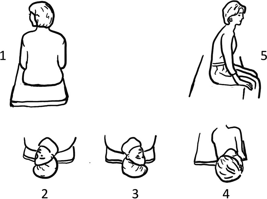 Figure: Left-sided Epley maneuver for left-sided posterior canal BPPV, as illustrated in Straumann and Brandt (Straumann and Brandt 2020).