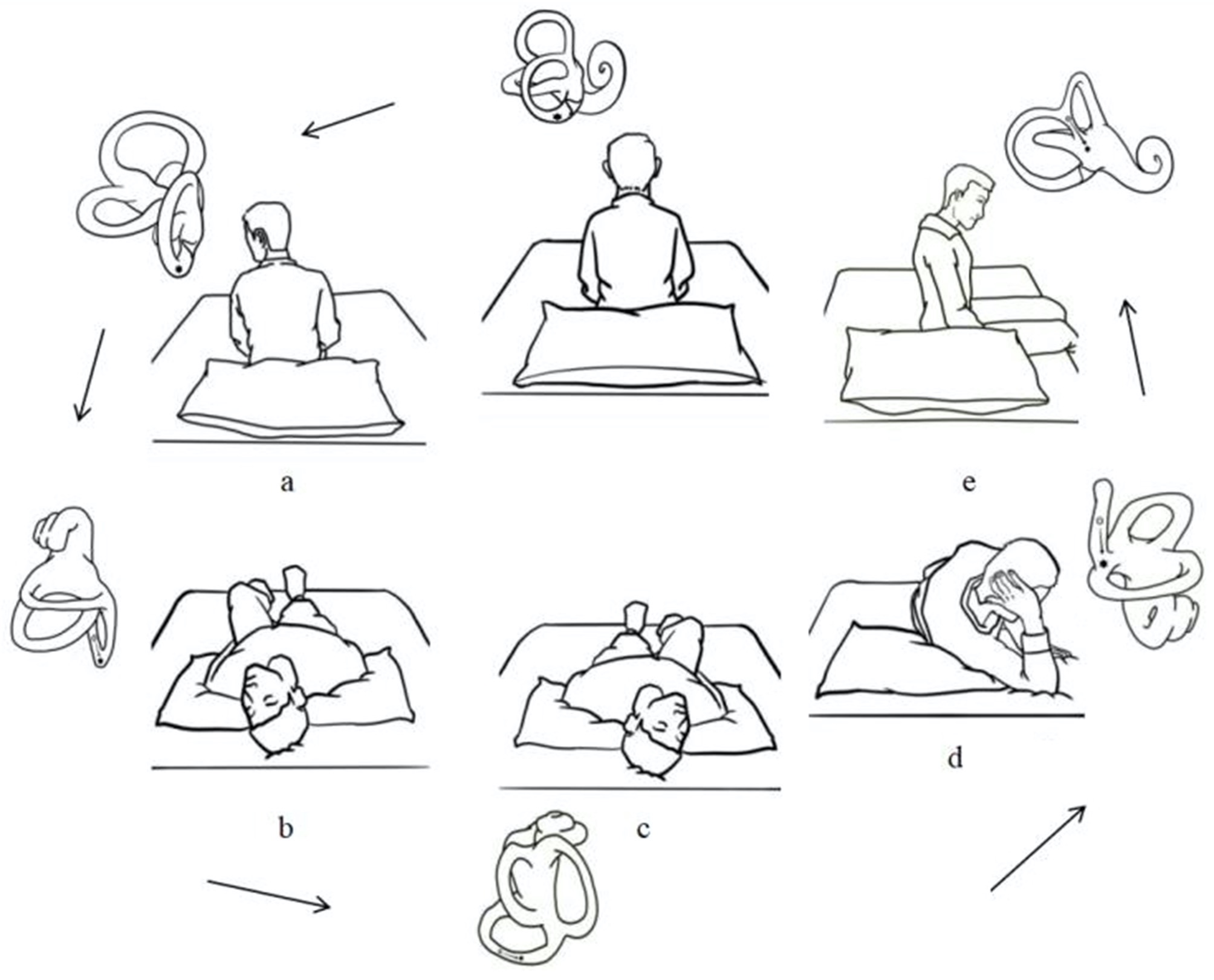 Figure: Modified Epley maneuver for treating left-sided posterior canal BPPV. From Gan et al. (Gan et al. 2021).