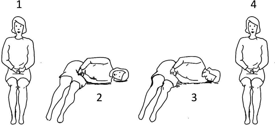 Figure: Gufoni maneuver for right-sided geotropic lateral canal BPPV. From Straumann and Brandt (Straumann and Brandt 2020).