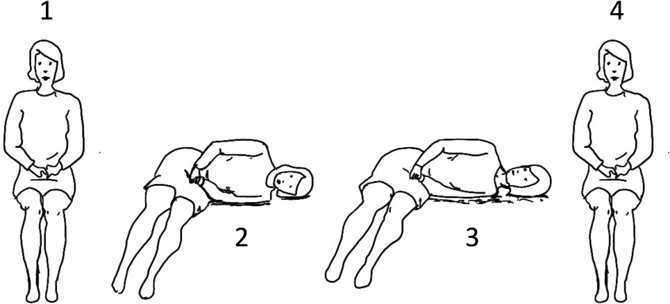 Figure: Gufoni maneuver for left-sided apogeotropic lateral canal BPPV. From Straumann and Brandt (Straumann and Brandt 2020).