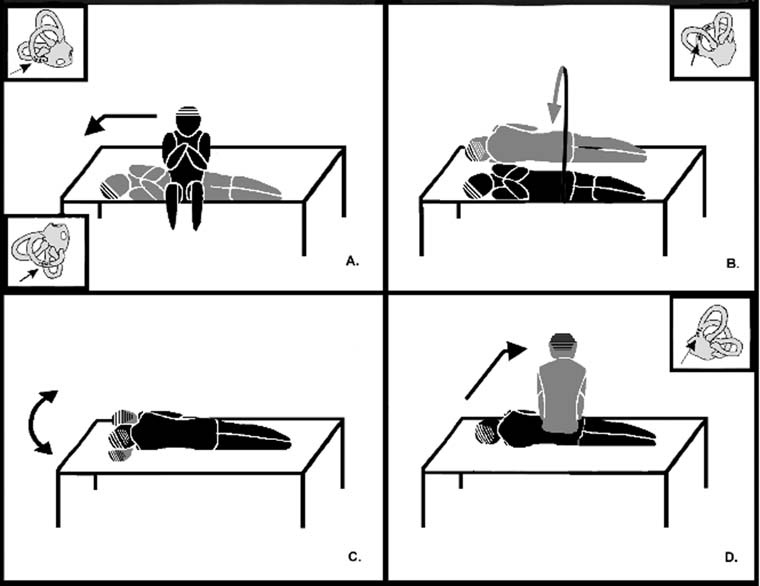 Figure: The Gans maneuver for treating right-sided posterior canal BPPV. From Roberts et al. (Roberts et al. 2006).
