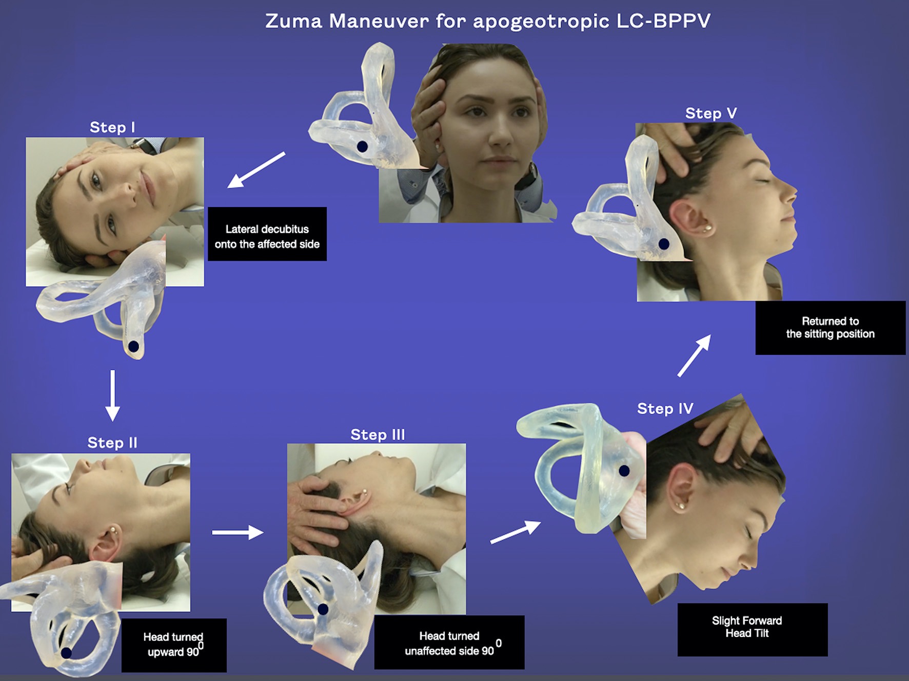 Figure: Right-sided Zuma maneuver for treating right-sided lateral canal apogeotropic BPPV. From (Ramos et al. 2022).