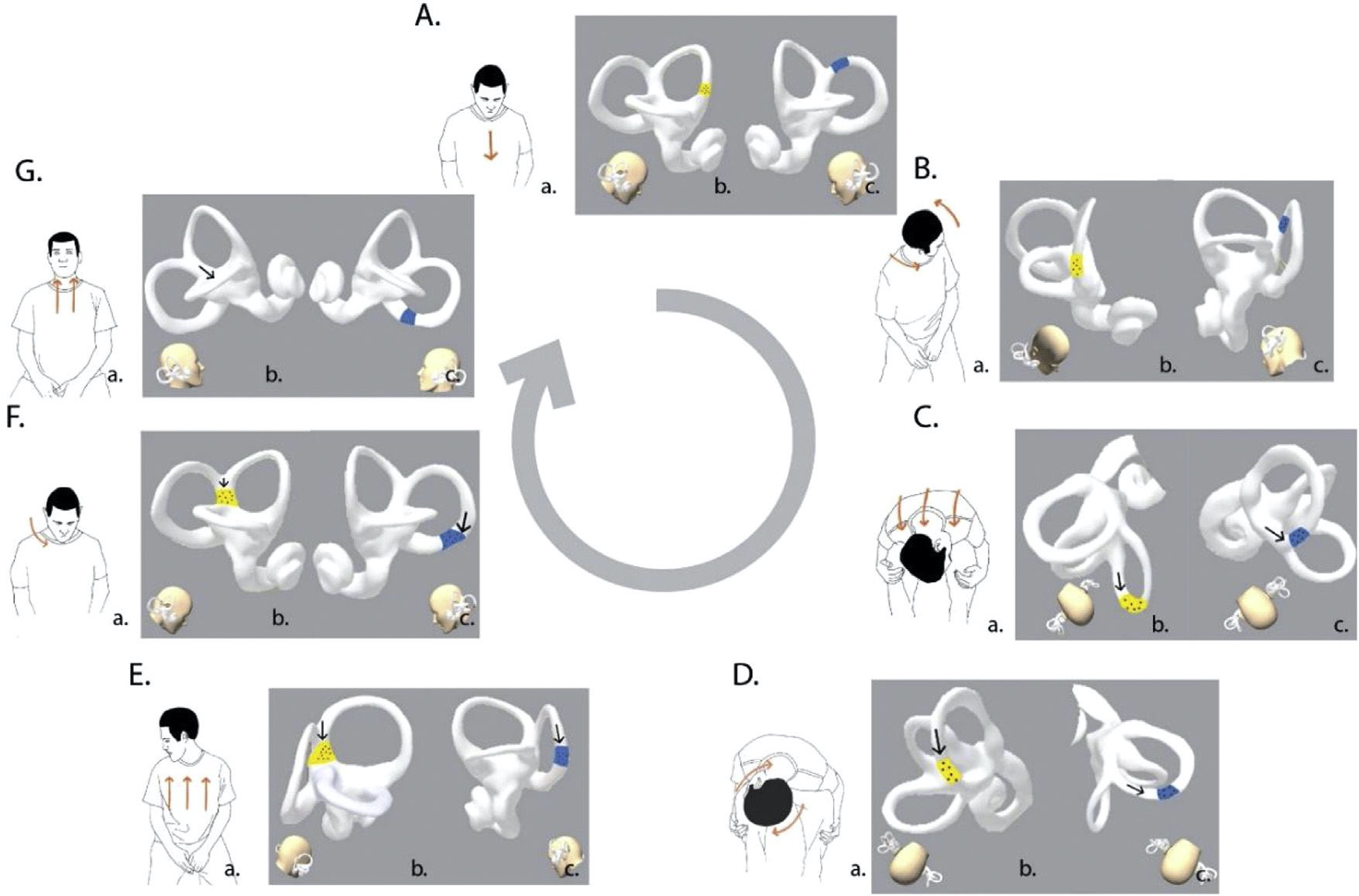 Figure: Garaycochea maneuver for treating right-sided anterior canal BPPV. From Garaycochea et al. (Garaycochea et al. 2022).