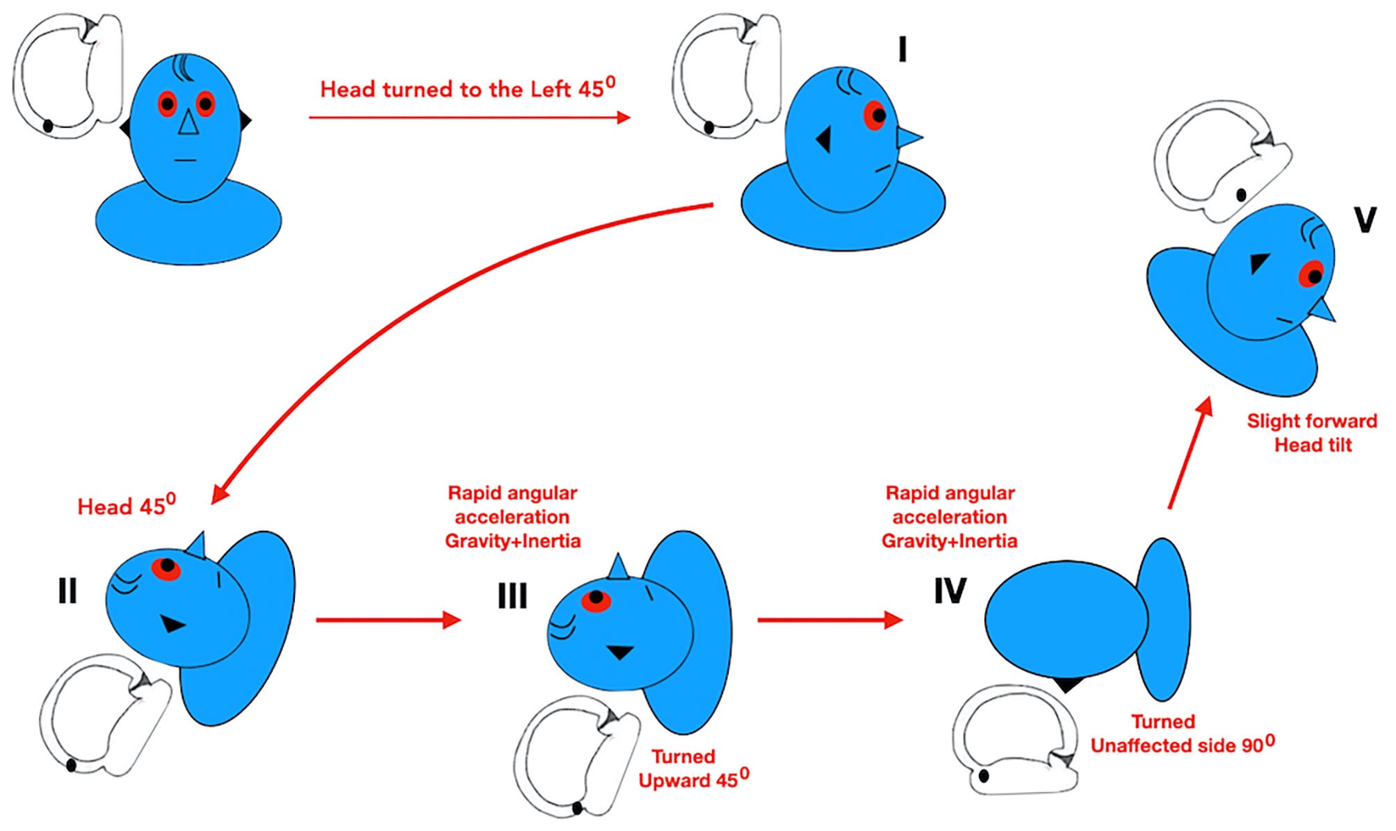 Figure: Modified Zuma maneuver to treat right-sided geotropic lateral canal BPPV. From Zuma e Maia et al. (Zuma et al. 2020).