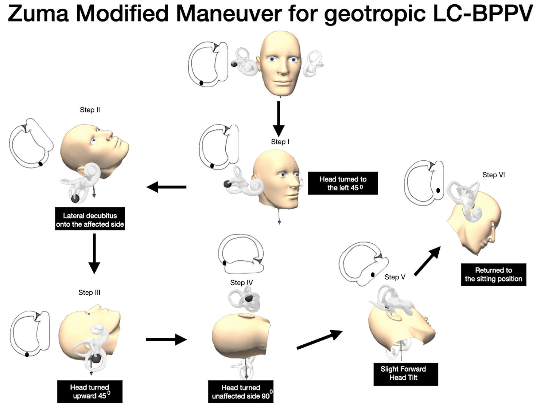 The role of the reversed nystagmus during Zuma maneuver in patients treated  for geotropic lateral canal benign paroxysmal positional vertigo - Journal  of the Neurological Sciences