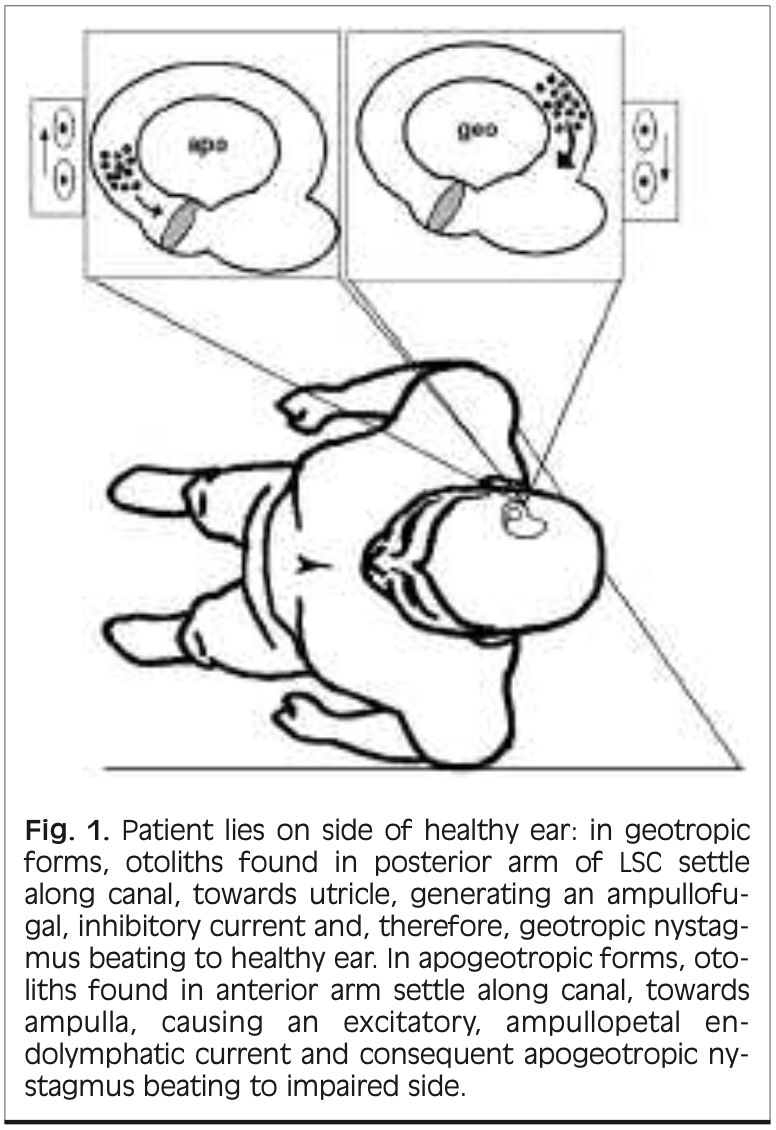 Figure: Lateral canal BPPV canalolithiasis, geotropic and apogeotropic variants, with patient lying on the unaffected side. From Asprella Libonati (Asprella Libonati 2005).