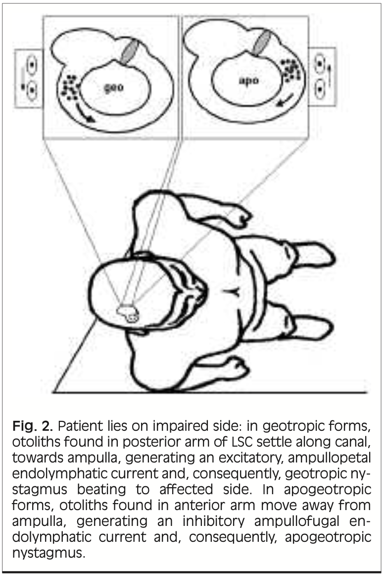 Figure: Lateral canal BPPV canalolithiasis, geotropic and apogeotropic variants, with patient lying on the unaffected side. From Asprella Libonati (Asprella Libonati 2005).