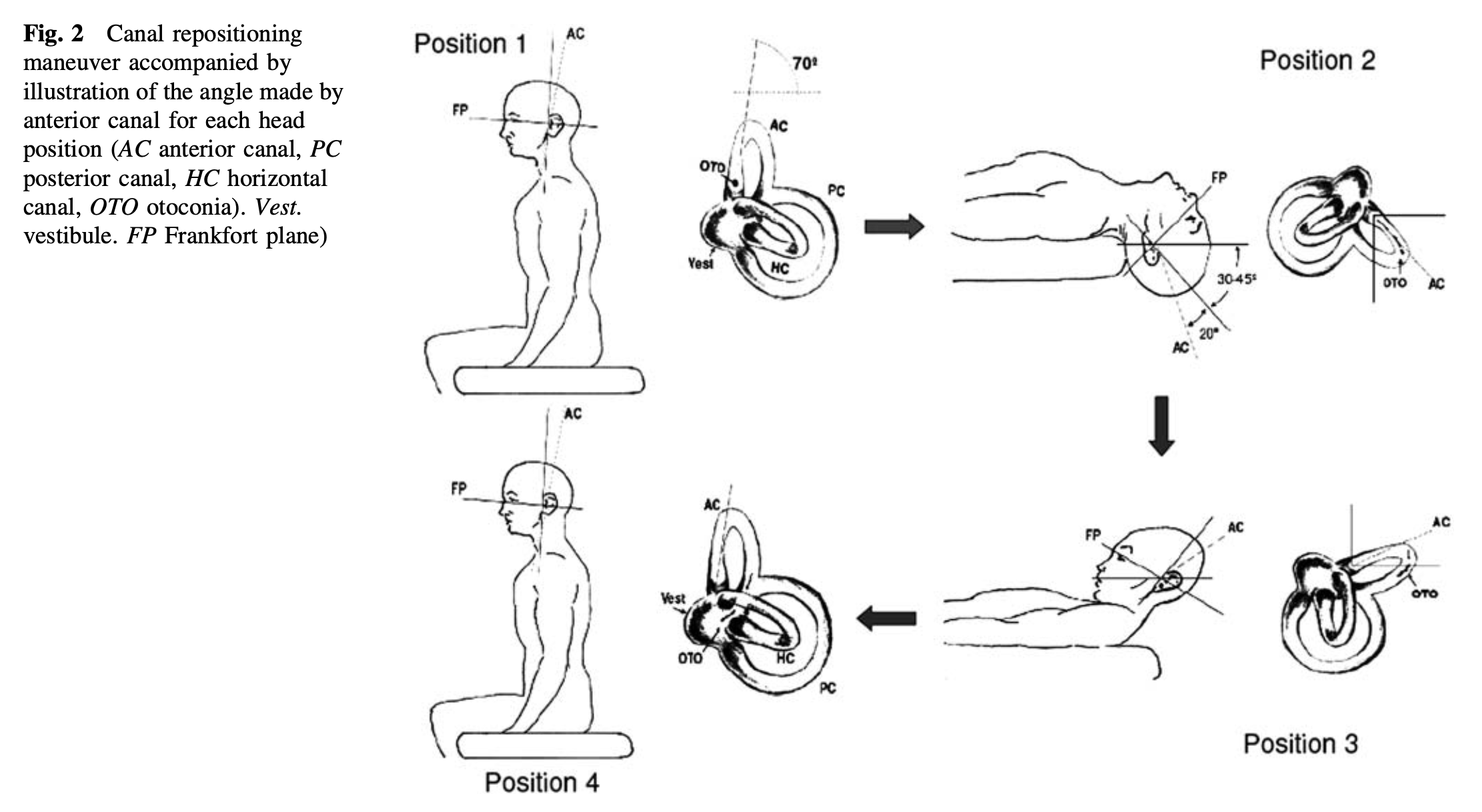 Yacovino maneuver.  Figure from Yacovino et al. (2009).