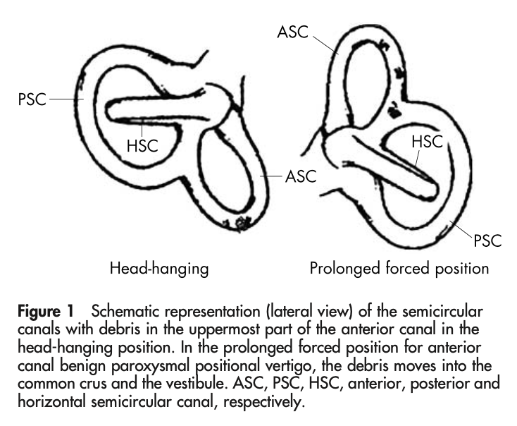 Figure: Illustrations of the labyrinth in the first and second positions of the Crevits prolonged forced position procedure. From Crevits (Crevits 2004).