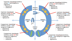 Physiology underlying the combined use of the “bow and lean test” (forward-backward tilt) and the “side lean test” (right-left tilt) for determining the posterior-anterior (geotropic-apogeotropic) and side (right-left) involvement of lateral canal benign paroxysmal positional vertigo (BPPV) canalolothiasis. Figure by Marcello Cherchi.