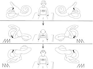 Cupulolithiasis type of horizontal semicircular canal benign paroxysmal positional vertigo (BPPV) in “bow and lean test.” The affected ear is determined as the same direction as the fast phase of nystagmus in the lean (head tilted backward) position, and in the opposite direction as the fast phase of nystagmus in the bow (head tilted forward) position. From Choung et al. (Choung et al. 2006).