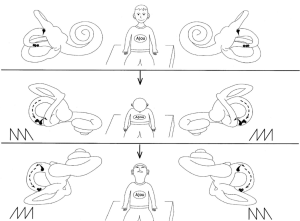 Canalolithiasis type of horizontal semicircular canal benign paroxysmal positional vertigo (BPPV) in “bow and lean test.” The affected ear is determined as the same direction as the fast phase of nystagmus in the bow (head tilted forward) position, and opposite the fast phase of nystagmus in the lean (head tilted backward) position. From Choung et al. (Choung et al. 2006).