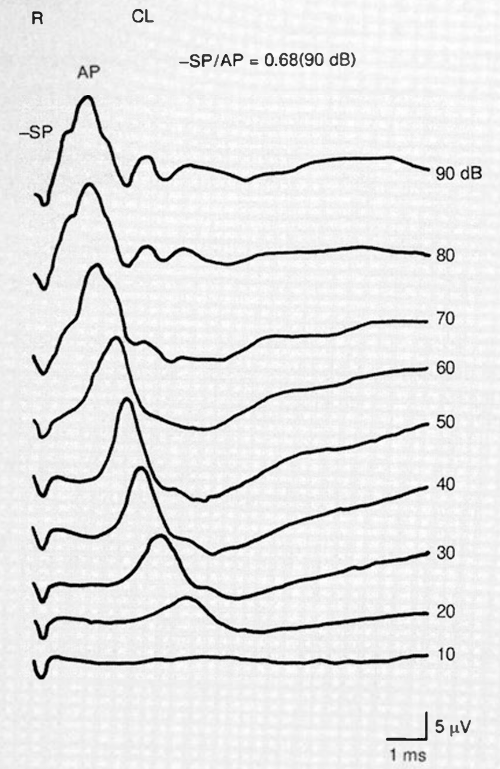 Transtympanic electrocochleography in a patient with Behcet disease showing an elevated SP/AP ratio at 80 dB – 90 dB. From Igarashi et al. (Igarashi et al. 1994).