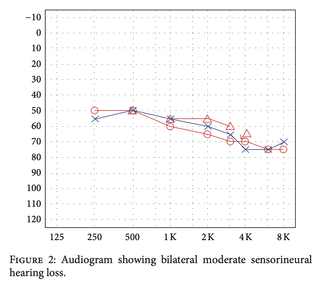 Audiogram from a patient with Cogan syndrome showing approximately symmetrical, high greater than low frequency sensorineural hearing loss.  From Azami et al. (Azami et al. 2014).
