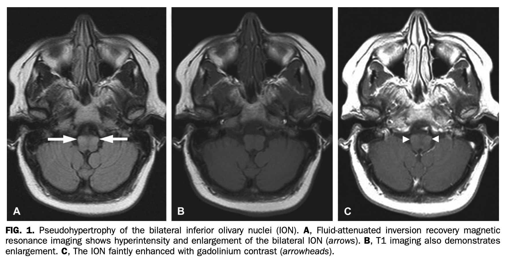 Axial MRI demonstrating Involvement of bilateral inferior olives in a patient with Behcet disease who had oculopalatal tremor.  From Morgan et al. (Morgan et al. 2015).