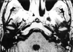 Axial MRI without contrast of a patient with Cogan syndrome showing T1 hyperintensity in the labyrinths.  From Garcia Berrocal et al. (García Berrocal et al. 1999).