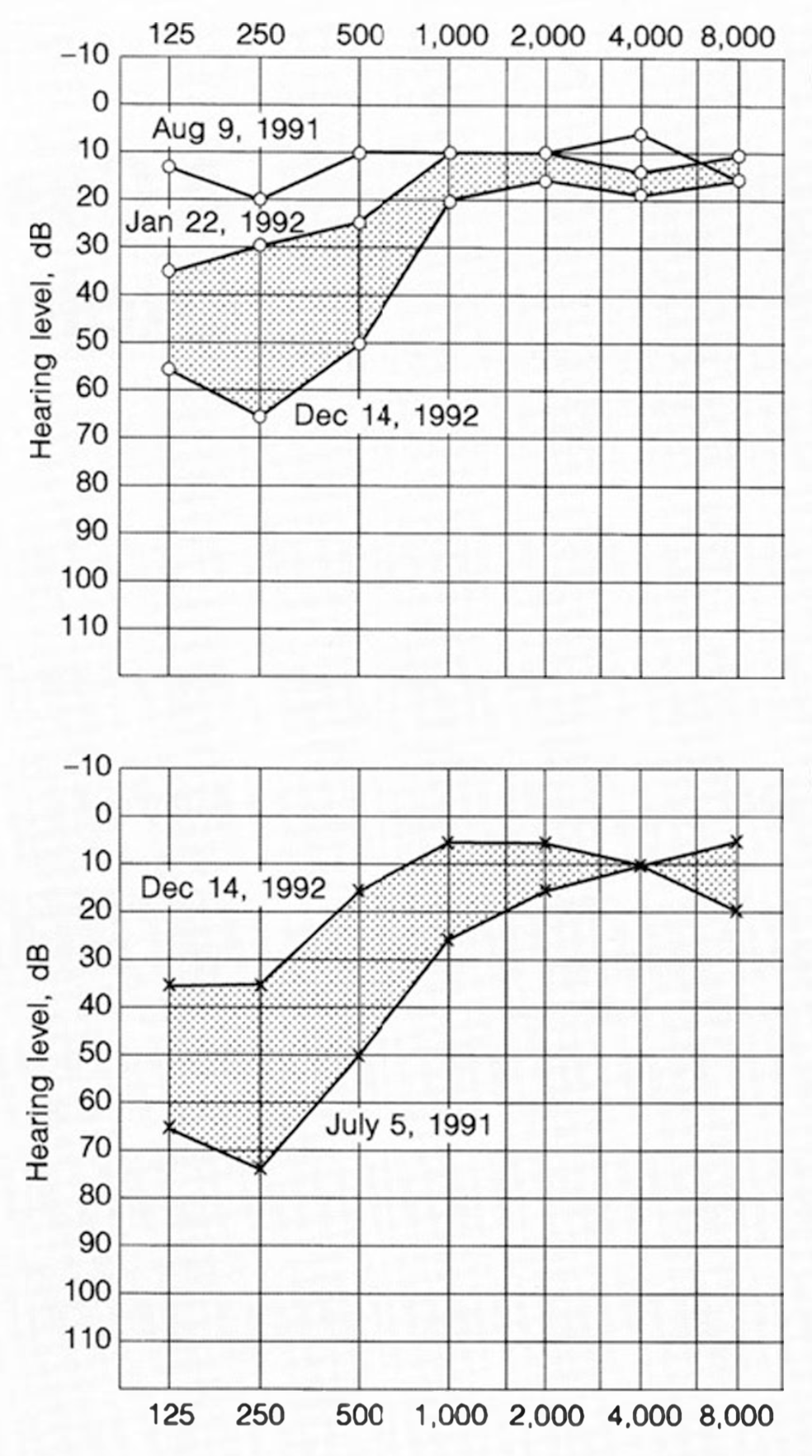 Bilateral fluctuating low frequency sensorineural hearing loss in a patient with Behcet disease.  From Igarashi et al. (Igarashi et al. 1994)
