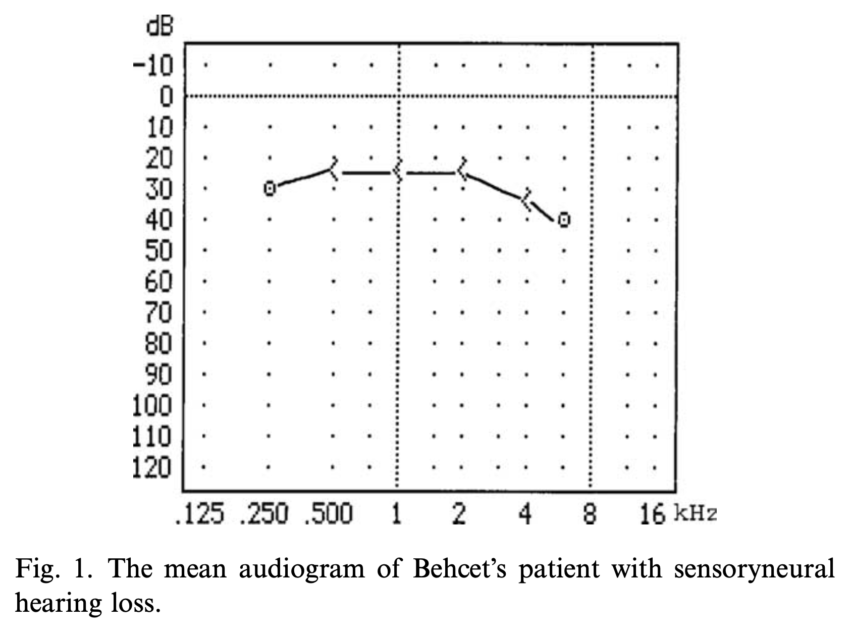 Composite audiogram from 62 Behcet disease patients.  From Kulahli et al. (Kulahli et al. 2005).