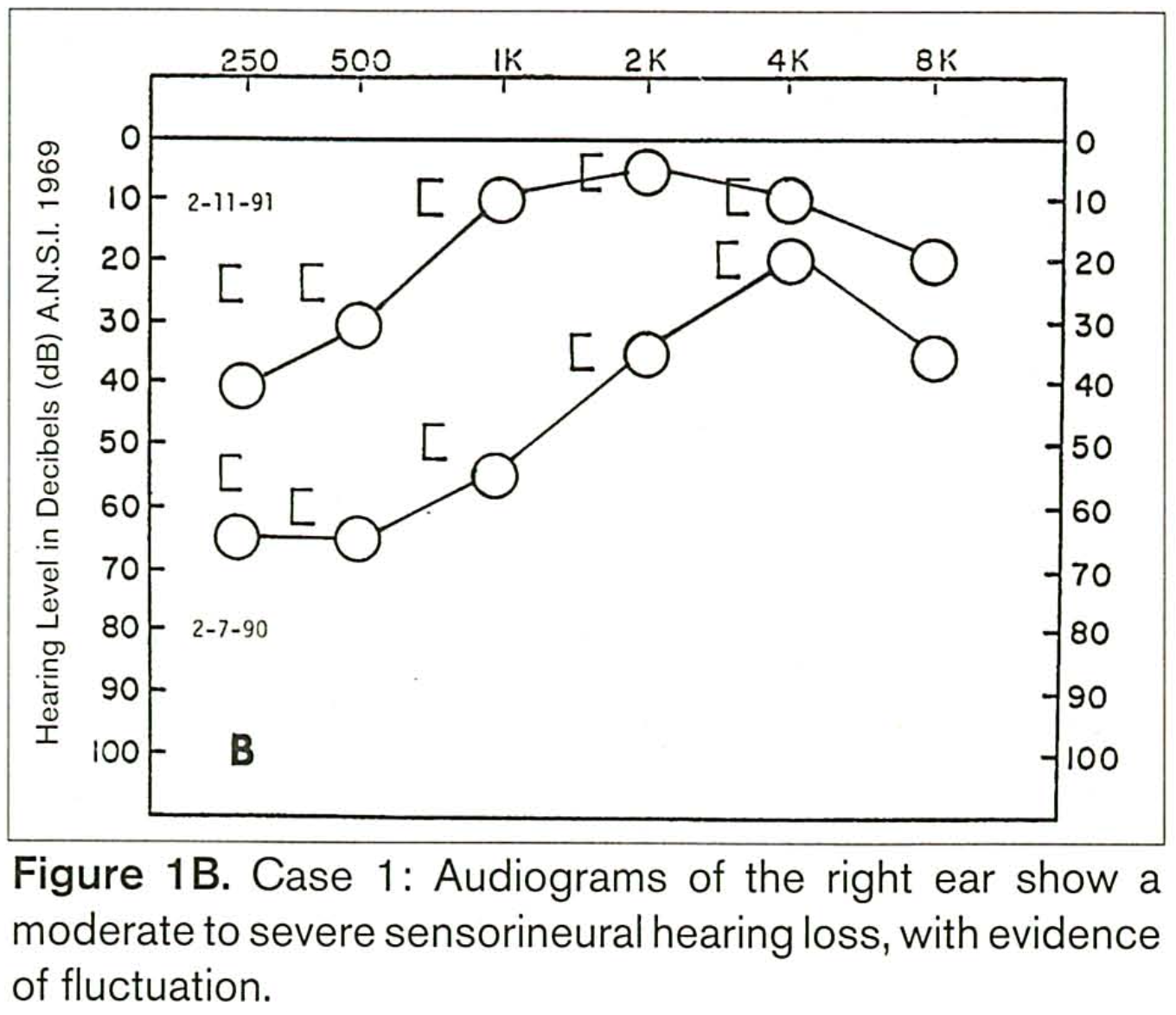 Composite audiogram of the right ear from a patient with Cogan syndrome showing fluctuating low frequency sensorineural hearing loss.  From Benitez et al. (Benitez et al. 1999).