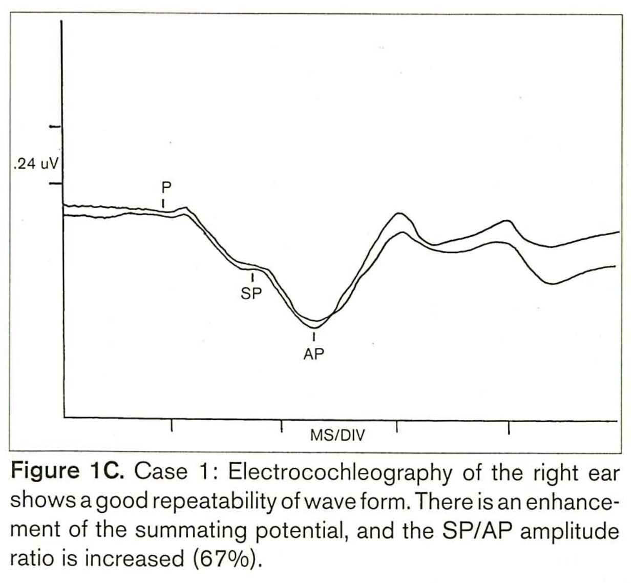 Electrocochleography from a patient diagnosed with Cogan syndrome showing an elevated SP/AP ratio.  From Benitez et al. (Benitez et al. 1999).