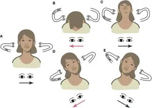 R geotropic BPPV. From Martellucci et al. (2020).