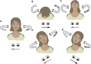 L geotropic BPPV. From Martellucci et al. (2020).