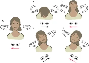 R apogeotropic BPPV. From Martellucci et al. (2020).