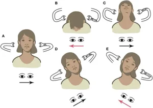 L apogeotropic BPPV. From Martellucci et al. (2020).