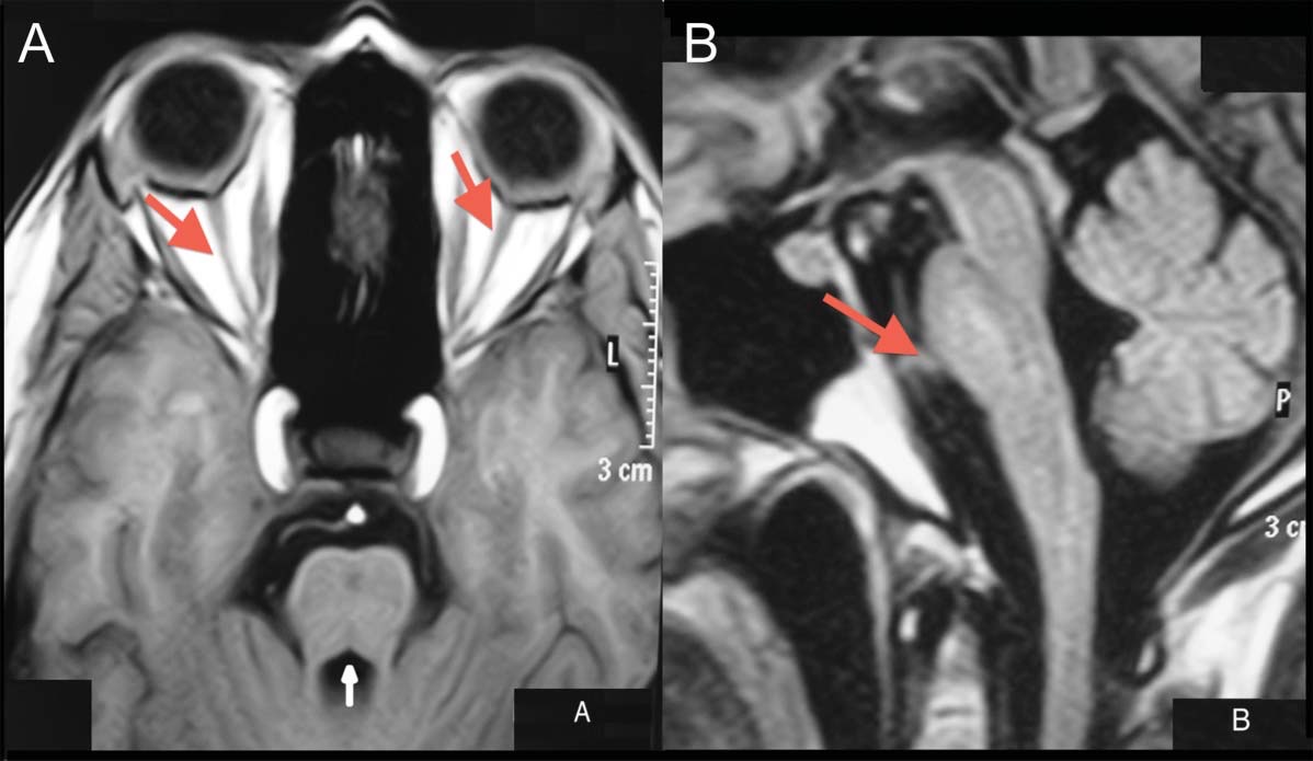 Figure : Wolfram syndrome type 1 in a 32-year-old man with deafness and insulin-dependent diabetes mellitus since infancy and a 4-year progressive visual loss and episodes of hyponatremia due to polyuria and polydipsia. Panel (A): Axial T1-weighted brain MRI shows bilateral optic nerve (red arrows) and pontine and middle cerebellar peduncle atrophy (white arrow). Panel (B): Sagittal T1-weighted brain MRI shows brainstem (particularly the pons; red arrow) and cerebellar atrophy. From Vale and Perpetuo (Vale and Perpetuo 2013).