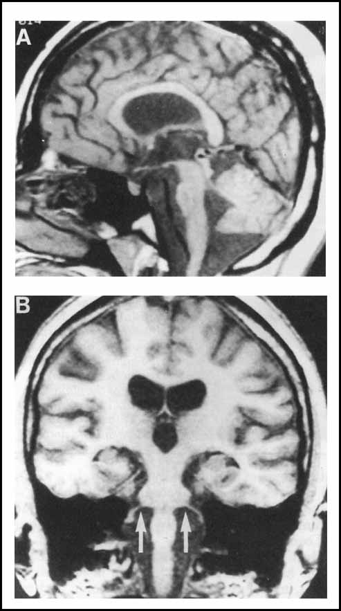 Figure : Panel (A): Sagittal T1-weighted MRI showing moderately severe atrophy of the brainstem and cerebellum. The fourth ventricle and the cisterna magna are enlarged. The optic chiasm appears thin. Panel (B): Coronal T1-weighted MRI. The cortical sulci are prominent (particularly the Sylvian fissures) and there is ventricular dilation, suggesting cortical and subcortical atrophy. The brainstem appears shrunken. The eight cranial nerves (arrows) appear normal. From Rando et al. (Rando et al. 1992).