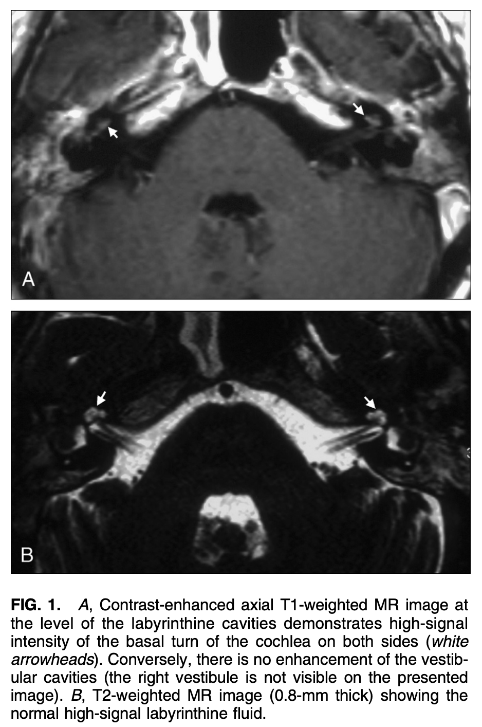 Panel (A): Contrast-enhanced axial T1-weighted MR image at the level of the labyrinthine cavities demonstrates high signal intensity of the basal turn of the cochlea on both sides (white arrowheads).  Conversely, there is no enhancement of the vestibular cavities.  Panel (B): T2-weighted MR image shows normal high-signal labyrinthine fluid.  From Teszler et al. (Teszler et al. 2008).