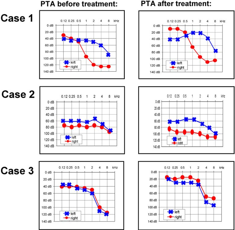Pure tone audiogram (PTA) before and after treatment with systemic corticosteroids.  From Baumann et al. (Baumann et al. 2005).