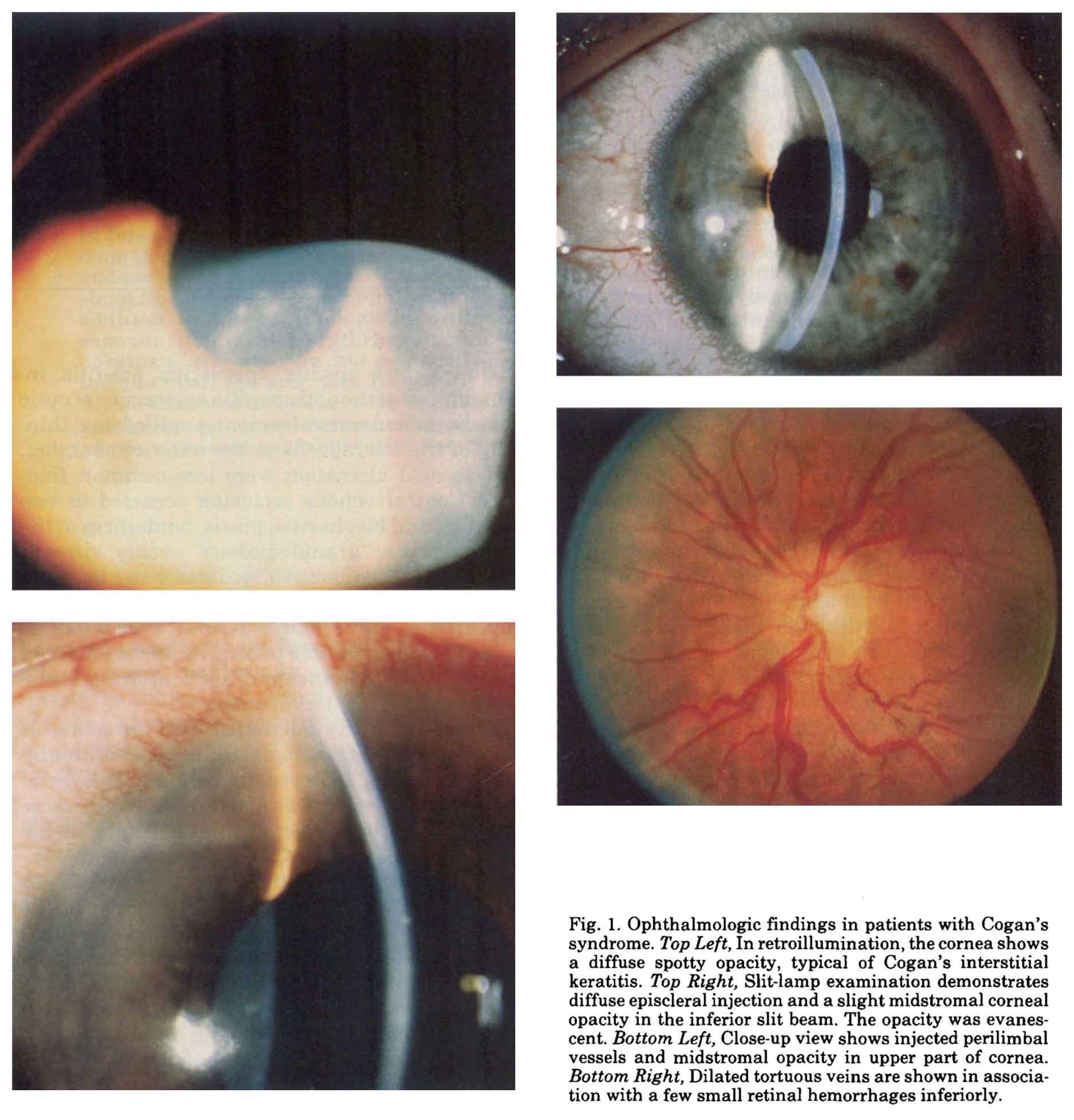 Representative ophthalmologic findings in Cogan syndrome.  From Vollertsen et al. (Vollertsen et al. 1986).