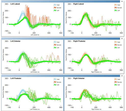 Video head impulse testing in a patient with Behcet disease.  Results in the left lateral canal (upper left panel) and left posterior canal (lower left panel) show low gain and covert compensatory saccades.  From Ertugrul et al. (Ertugrul et al. 2019).
