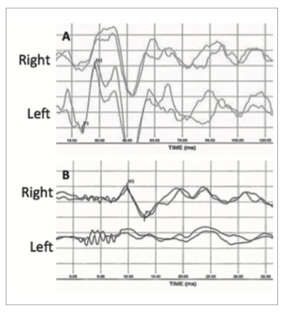 Air-conducted cervical vestibular evoked myogenic potentials (cVEMPs) and bone-conducted ocular vestibular evoked myogenic potentials (oVEMPs) in a case of right-sided Lindsay-Hemenway syndrome reported by Casani and colleagues (Casani et al. 2018).  The cVEMP responses were absent on the right side (reflecting a right-sided vestibular weakness).  The oVEMP responses were absent on the left side (reflecting a right-sided vestibular weakness).