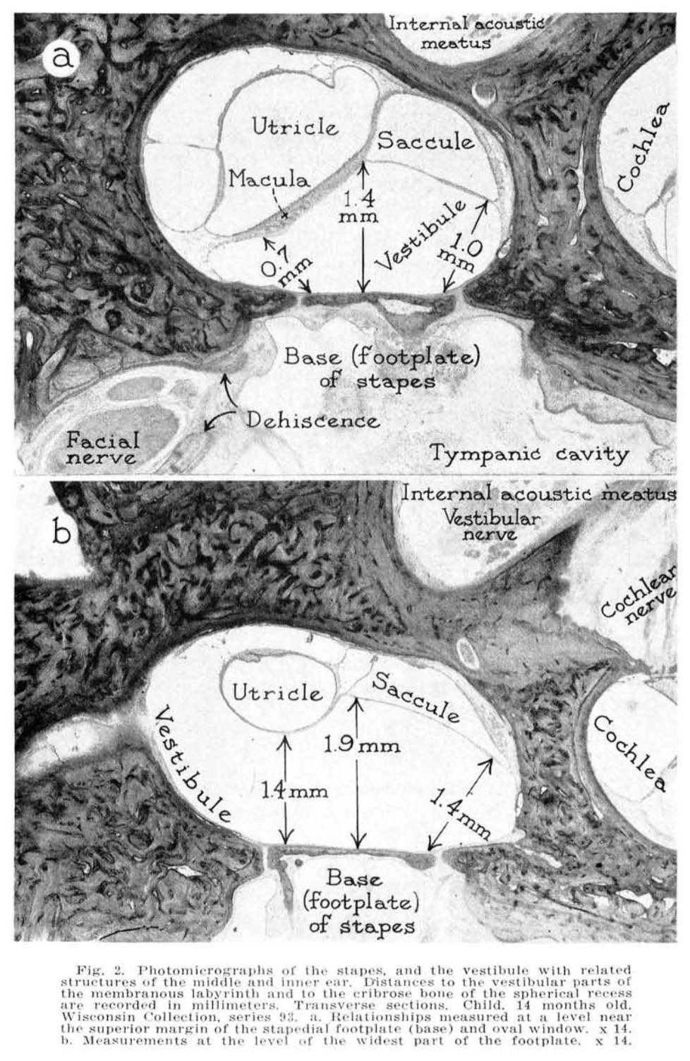 Photomicrographs of the stapes, and the vestibule with related structures of the middle and inner ear.  From Anson et al. (1965).