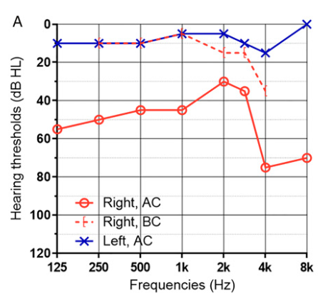 Preoperative audiogram from a patient with right-sided stapes subluxation from penetrating trauma.  There is right-sided conductive hearing loss.  From Lee et al. (2025).