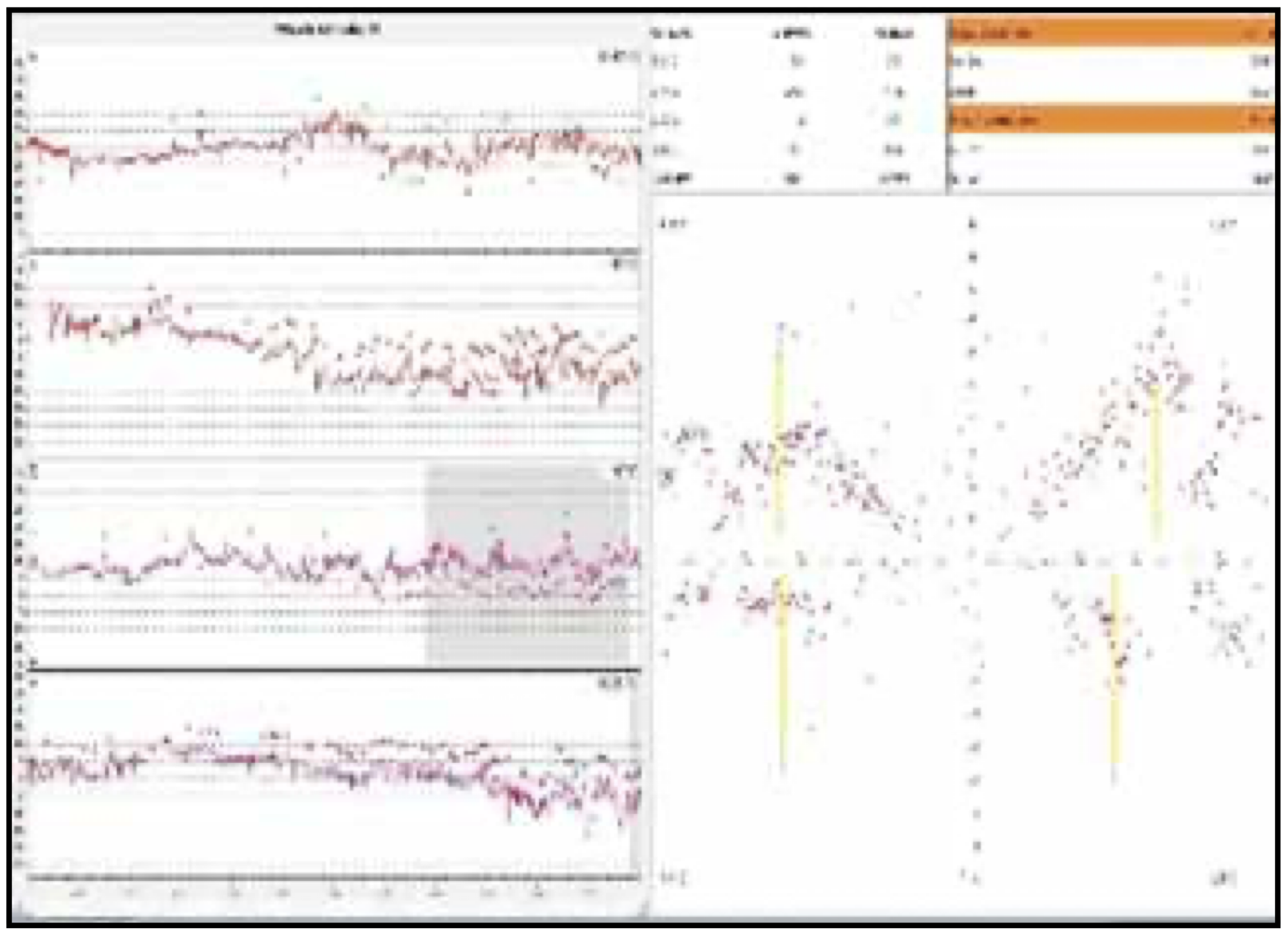 Results of caloric testing in a patient with right-sided Lindsay-Hemenway syndrome reported by Anghel and colleagues (Anghel et al. 2020).  The figure in the original article is of poor quality, but shows right-sided caloric weakness.