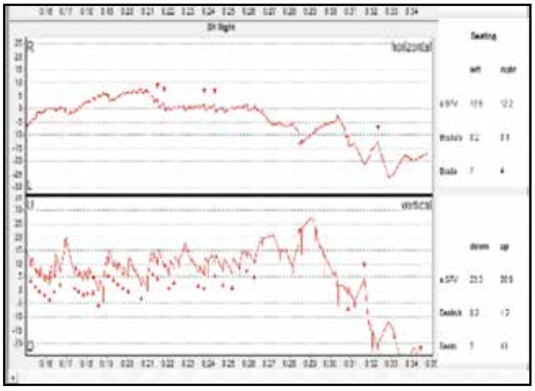 Results of videonystagmography (VNG) in the right-sided Dix-Hallpike position in a patient with right-sided Lindsay-Hemenway syndrome reported by Anghel and colleagues (Anghel et al. 2020).  The figure in the original article is of poor quality; the authors of the paper interpret this as showing up beat and right torsional nystagmus, compatible with right-sided posterior canal benign paroxysmal positional vertigo (BPPV).