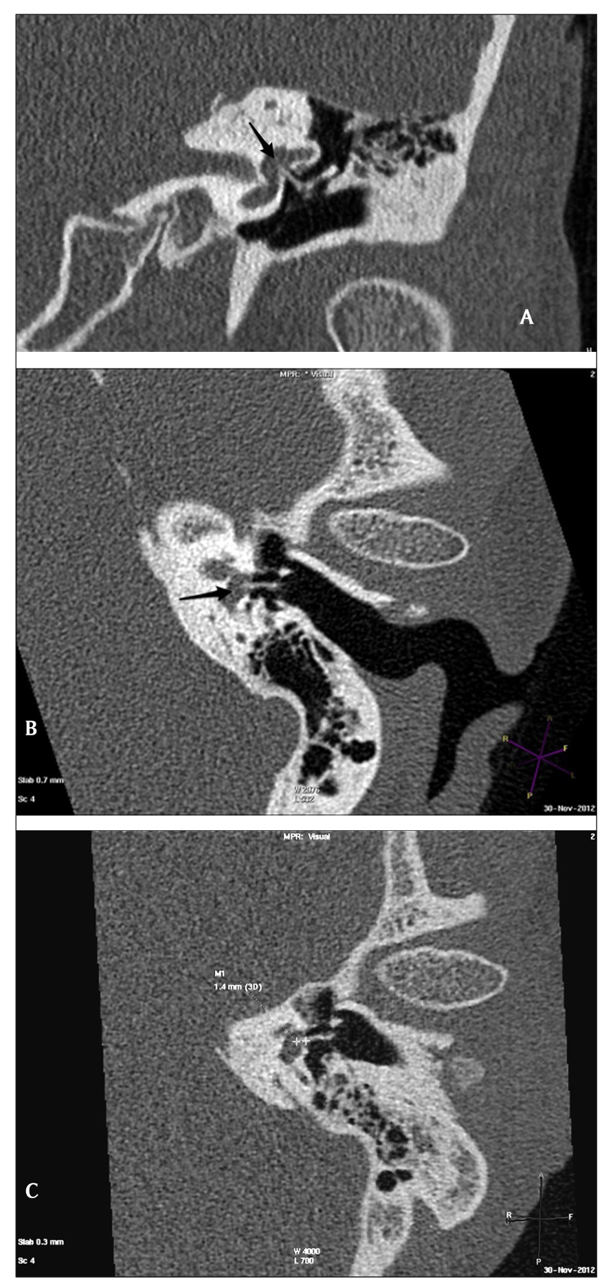 Temporal bone CT images demonstrating protrusion of a stapes prosthesis into the vestibule.  Panel A: para-coronal.  Panel B: para-axial.  Panel C: measurement of protrusion depth.  From Toirkens et al. (2015).