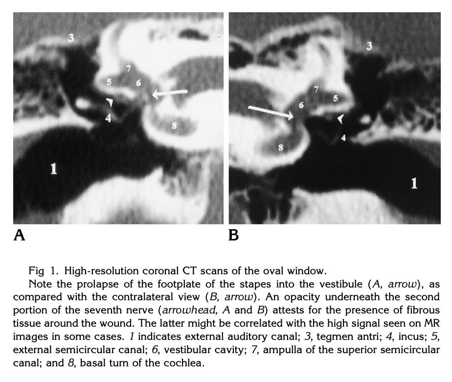 Temporal bone CT.  Panel A shows prolapse of the footplate of the stapes into the vestibule (arrow). Panel B shows the contralateral, normal ear.  From Herman et al. (1996).