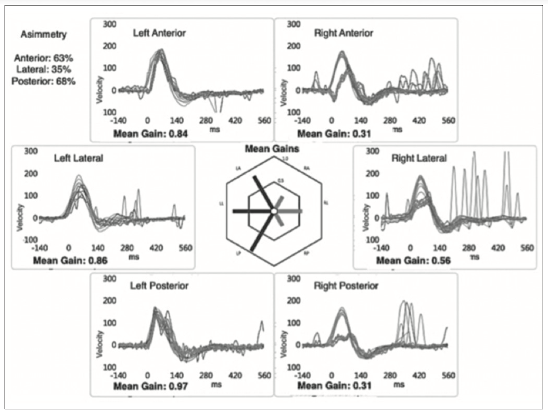 Video head impulse testing (vHIT) from a case of right-sided Lindsay-Hemenway syndrome reported by Casani and colleagues (Casani et al. 2018), showing low gain with overt compensatory saccades in all canals on the right side.