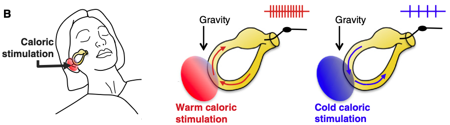 FIgure: One theory of how caloric irrigation elicits nystagmus. Stimulation of different temperatures elicits convection currents in different directions in the lateral semicircular canal. From Lopez and Blanke (Lopez and Blanke 2014).